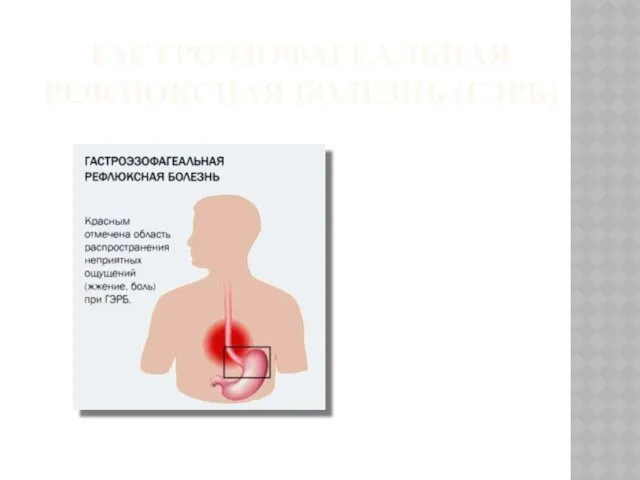 ГАСТРОЭЗОФАГЕАЛЬНАЯ РЕФЛЮКСНАЯ БОЛЕЗНЬ (ГЭРБ)