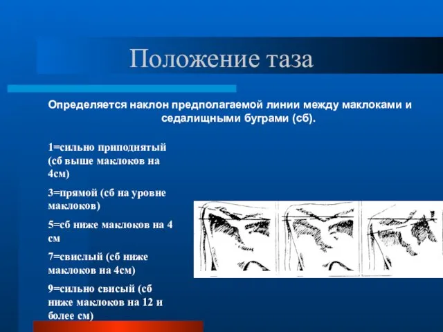 Положение таза Определяется наклон предполагаемой линии между маклоками и седалищными