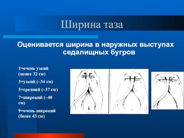 Ширина таза Оценивается ширина в наружных выступах седалищных бугров 1=очень