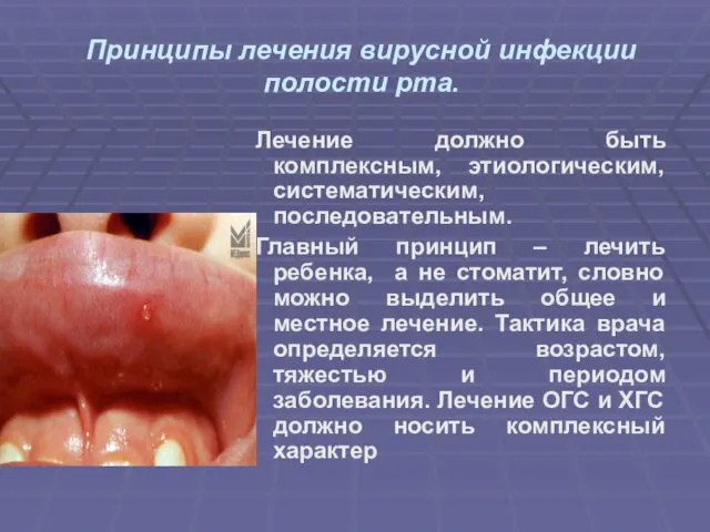 Принципы лечения вирусной инфекции полости рта. Лечение должно быть комплексным,