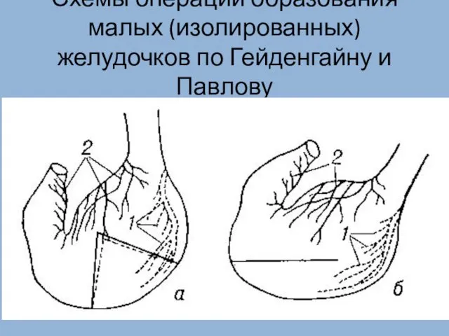 Схемы операции образования малых (изолированных) желудочков по Гейденгайну и Павлову