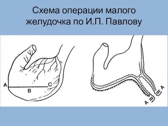 Схема операции малого желудочка по И.П. Павлову