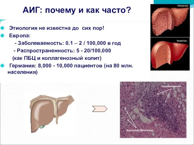 АИГ: почему и как часто? Этиология не известна до сих