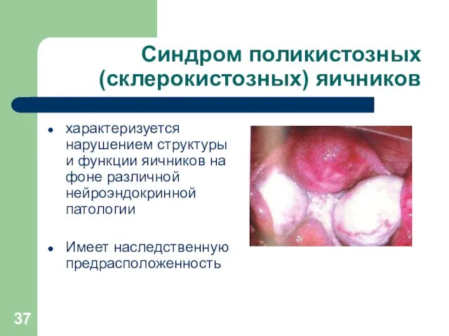 Синдром поликистозных (склерокистозных) яичников характеризуется нарушением структуры и функции яичников