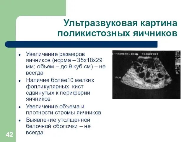 Ультразвуковая картина поликистозных яичников Увеличение размеров яичников (норма – 35х18х29 мм; объем –