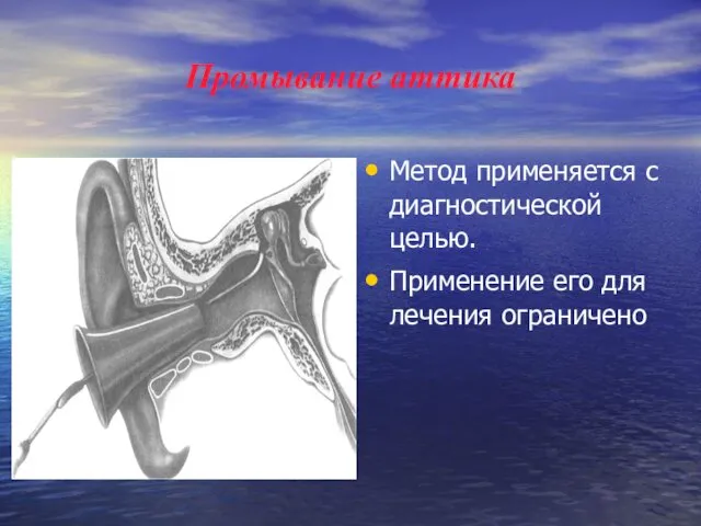 Промывание аттика Метод применяется с диагностической целью. Применение его для лечения ограничено