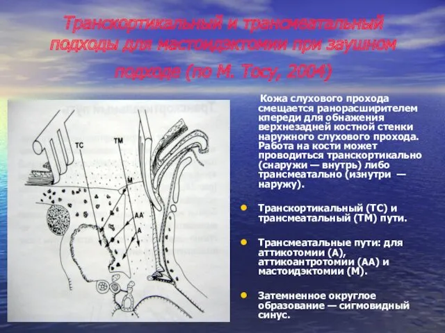 Транскортикальный и трансмеатальный подходы для мастоидэктомии при заушном подходе (по М. Тосу, 2004)