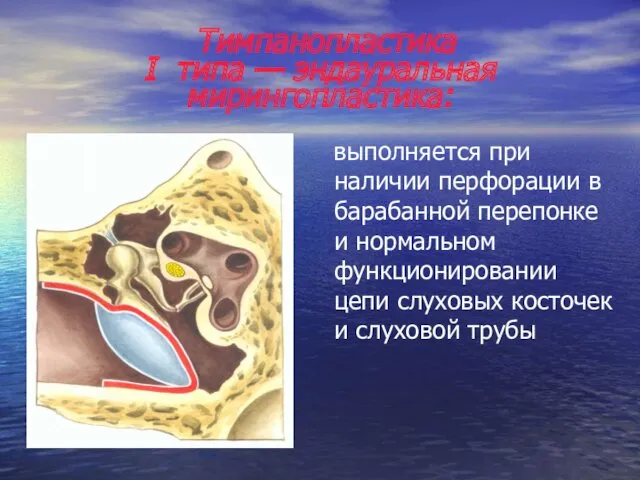 Тимпанопластика I типа — эндауральная мирингопластика: выполняется при наличии перфорации в барабанной перепонке