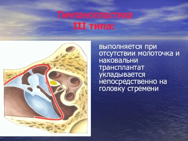 Тимпанопластика III типа: выполняется при отсутствии молоточка и наковальни трансплантат укладывается непосредственно на головку стремени