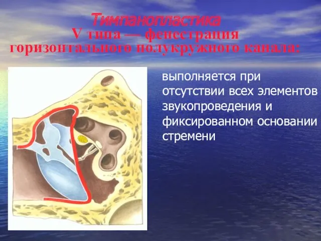 Тимпанопластика V типа — фенестрация горизонтального полукружного канала: выполняется при отсутствии всех элементов