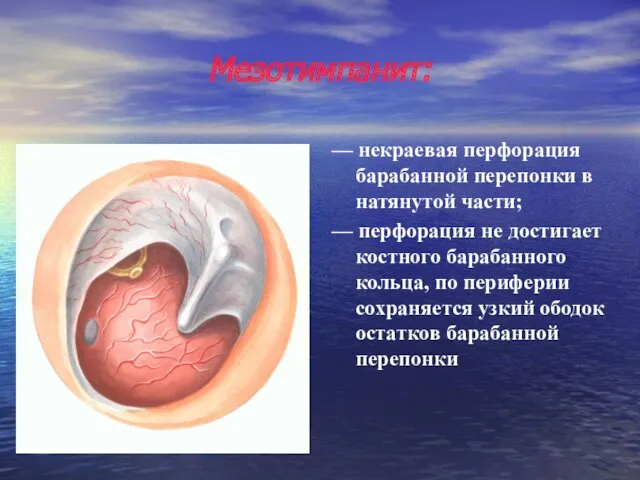 Мезотимпанит: — некраевая перфорация барабанной перепонки в натянутой части; —