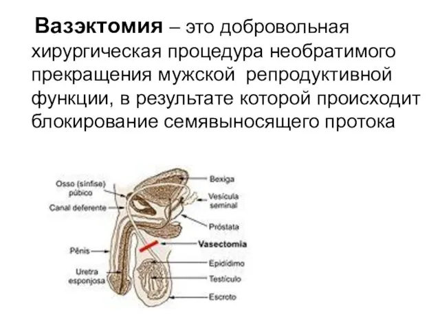 Вазэктомия – это добровольная хирургическая процедура необратимого прекращения мужской репродуктивной