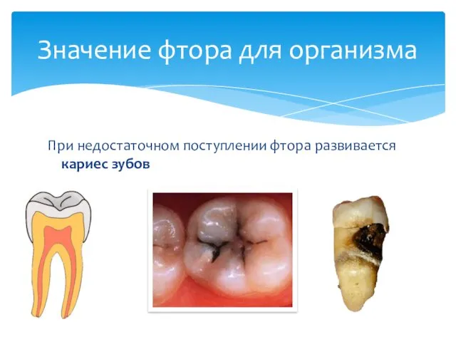 При недостаточном поступлении фтора развивается кариес зубов Значение фтора для организма