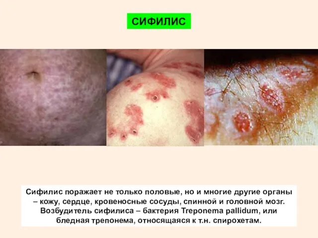 СИФИЛИС Сифилис поражает не только половые, но и многие другие органы – кожу,