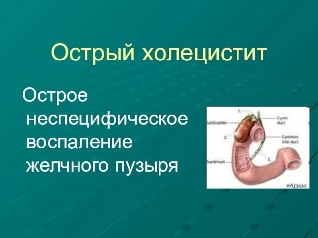 Острый холецистит Острое неспецифическое воспаление желчного пузыря