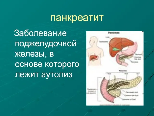 панкреатит Заболевание поджелудочной железы, в основе которого лежит аутолиз