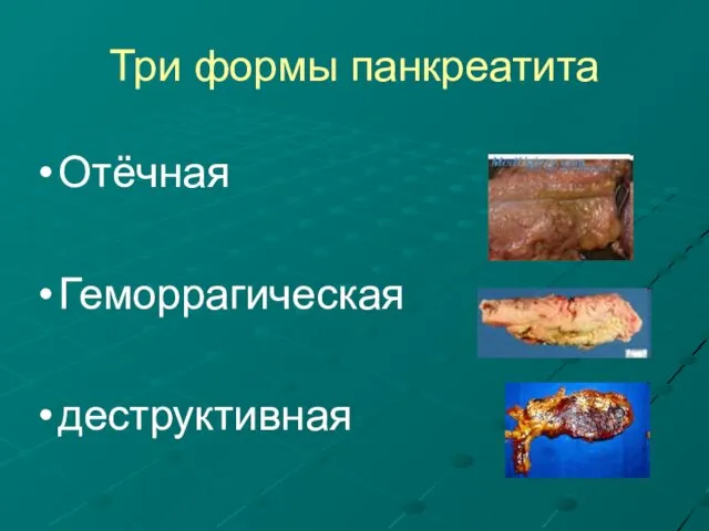 Три формы панкреатита Отёчная Геморрагическая деструктивная