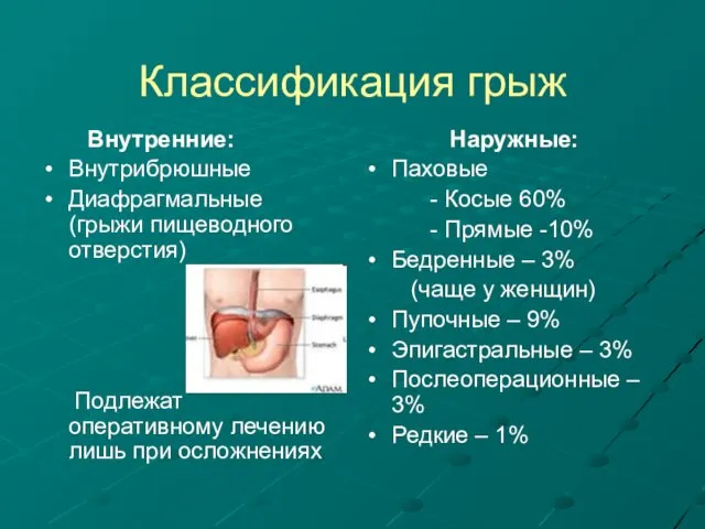 Классификация грыж Внутренние: Внутрибрюшные Диафрагмальные (грыжи пищеводного отверстия) Подлежат оперативному