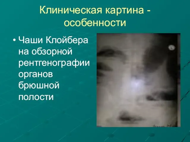 Клиническая картина - особенности Чаши Клойбера на обзорной рентгенографии органов брюшной полости