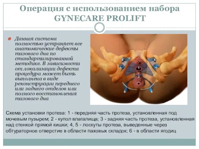 Операция с использованием набора GYNECARE PROLIFT Данная система полностью устраняет