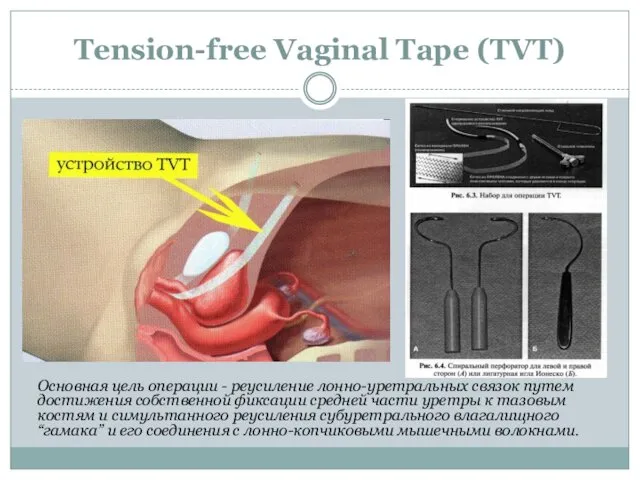 Tension-free Vaginal Tape (TVT) Основная цель операции - реусиление лонно-уретральных