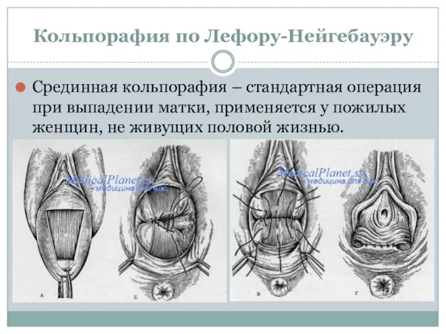 Кольпорафия по Лефору-Нейгебауэру Срединная кольпорафия – стандартная операция при выпадении