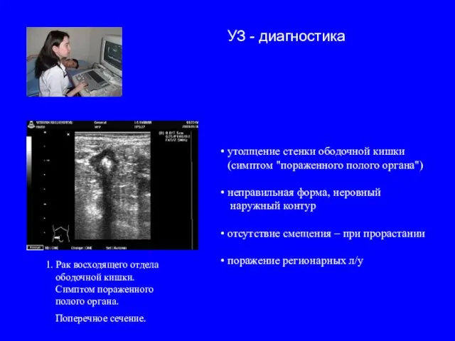 1. Рак восходящего отдела ободочной кишки. Симптом пораженного полого органа.