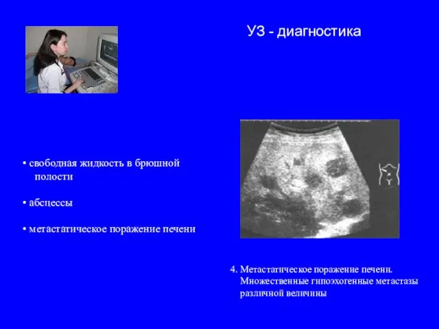 4. Метастатическое поражение печени. Множественные гипоэхогенные метастазы различной величины свободная