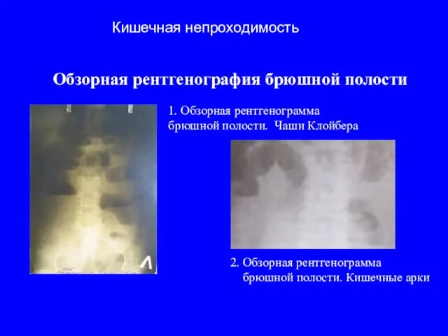 Обзорная рентгенография брюшной полости 1. Обзорная рентгенограмма брюшной полости. Чаши