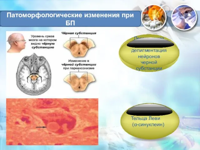 Патоморфологические изменения при БП