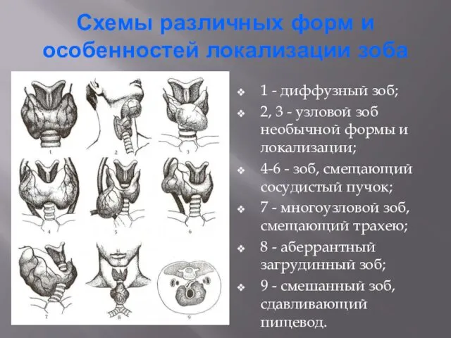 Схемы различных форм и особенностей локализации зоба 1 - диффузный