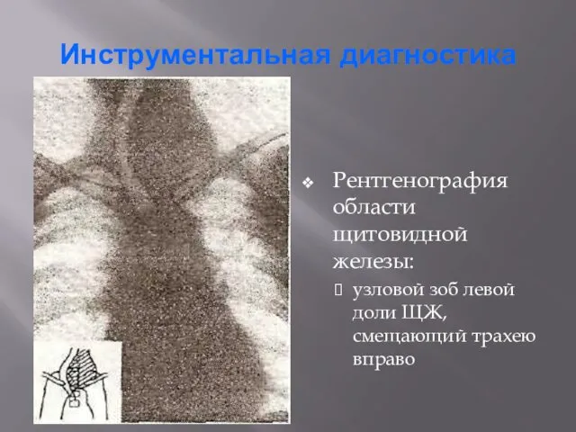 Инструментальная диагностика Рентгенография области щитовидной железы: узловой зоб левой доли ЩЖ, смещающий трахею вправо