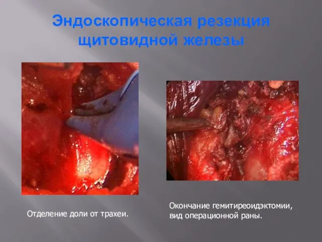 Эндоскопическая резекция щитовидной железы Отделение доли от трахеи. Окончание гемитиреоидэктомии, вид операционной раны.