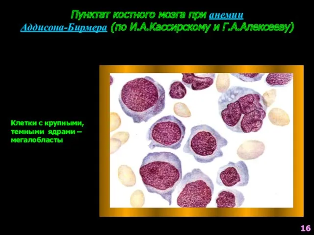 Пунктат костного мозга при анемии Аддисона-Бирмера (по И.А.Кассирскому и Г.А.Алексееву)