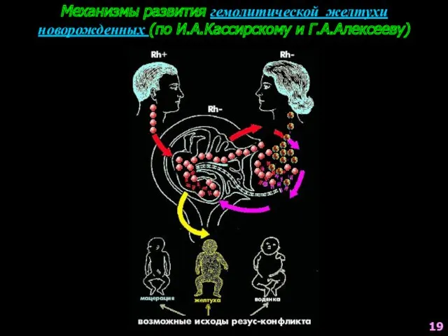 Механизмы развития гемолитической желтухи новорожденных (по И.А.Кассирскому и Г.А.Алексееву) 19