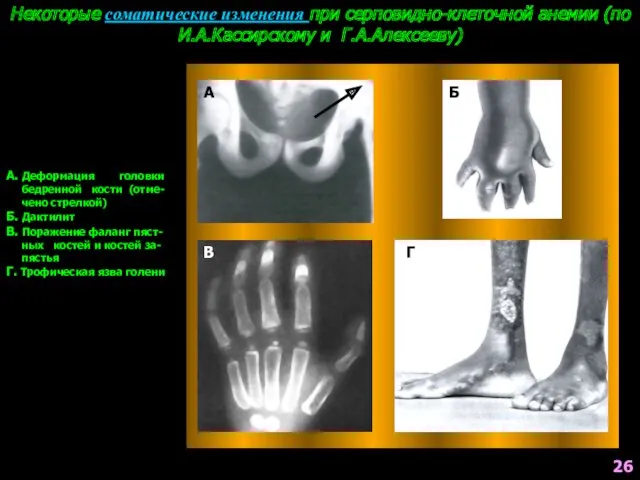 Некоторые соматические изменения при серповидно-клеточной анемии (по И.А.Кассирскому и Г.А.Алексееву)