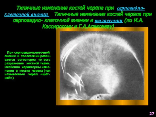 Типичные изменения костей черепа при серповидно- клеточной анемии Типичные изменения