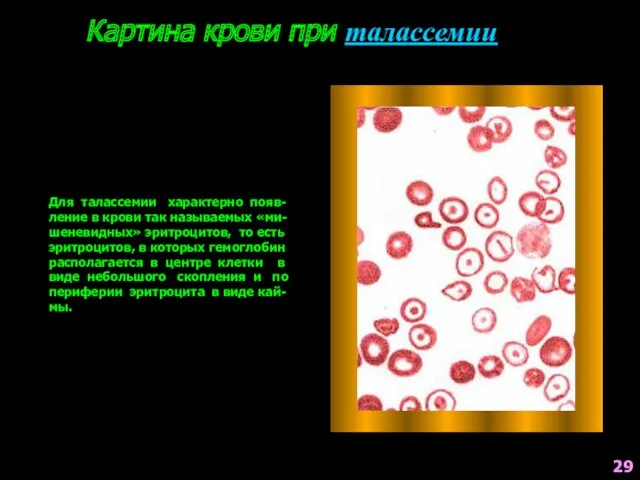 Картина крови при талассемии Для талассемии характерно появ-ление в крови