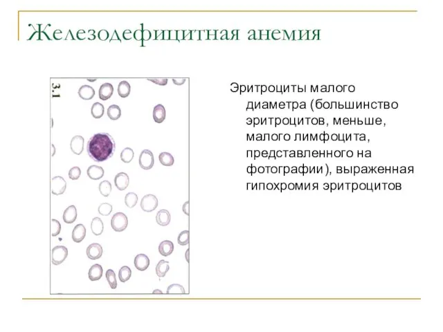 Железодефицитная анемия Эритроциты малого диаметра (большинство эритроцитов, меньше, малого лимфоцита, представленного на фотографии), выраженная гипохромия эритроцитов