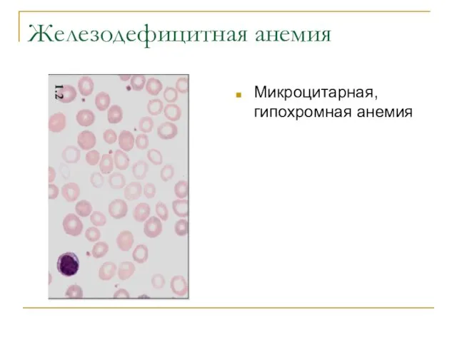 Железодефицитная анемия Микроцитарная, гипохромная анемия