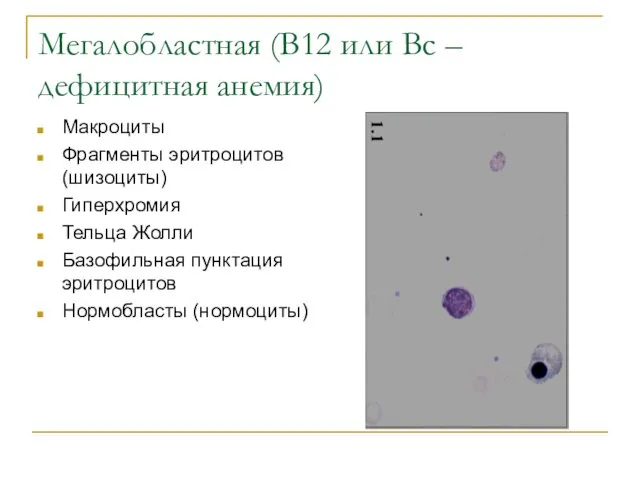 Мегалобластная (В12 или Вс –дефицитная анемия) Макроциты Фрагменты эритроцитов (шизоциты)