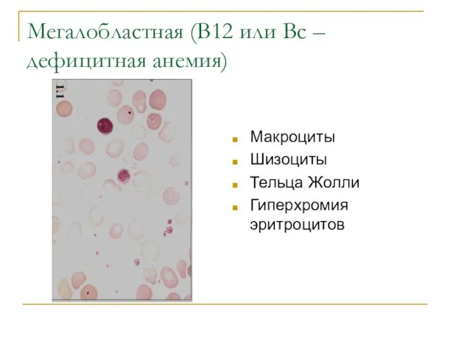 Мегалобластная (В12 или Вс –дефицитная анемия) Макроциты Шизоциты Тельца Жолли Гиперхромия эритроцитов