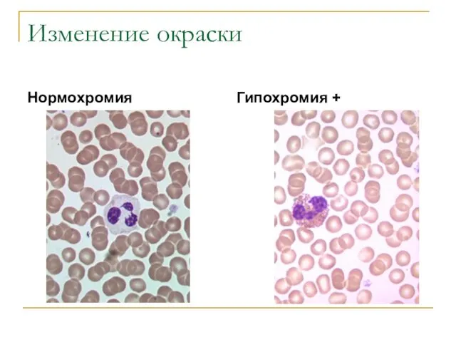 Изменение окраски Нормохромия Гипохромия +