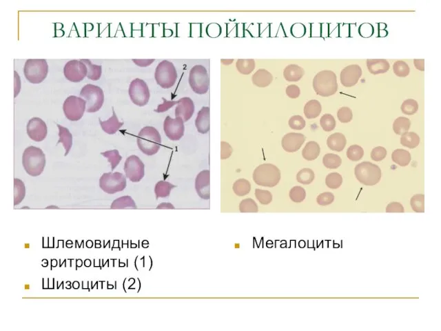 ВАРИАНТЫ ПОЙКИЛОЦИТОВ Шлемовидные эритроциты (1) Шизоциты (2) Мегалоциты