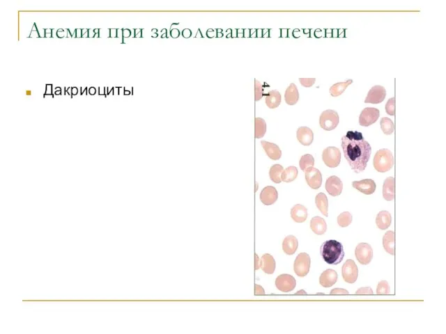 Анемия при заболевании печени Дакриоциты