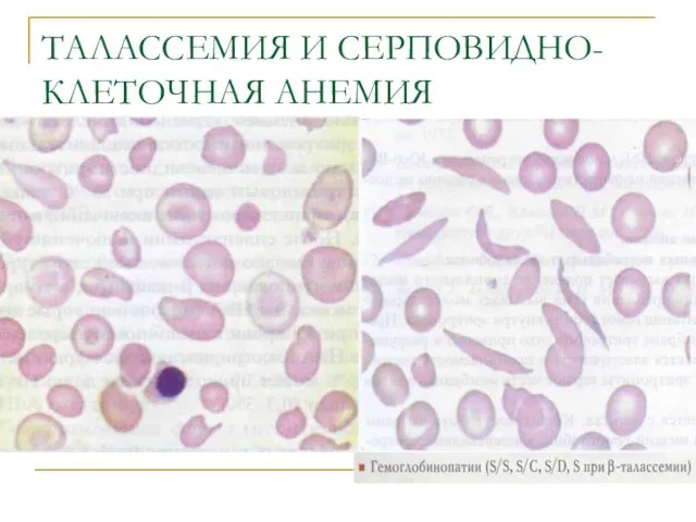 ТАЛАССЕМИЯ И СЕРПОВИДНО-КЛЕТОЧНАЯ АНЕМИЯ