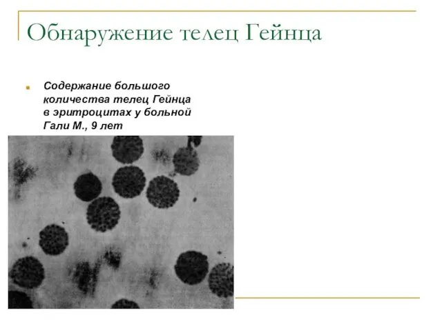 Обнаружение телец Гейнца Содержание большого количества телец Гейнца в эритроцитах у больной Гали М., 9 лет