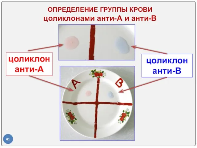 цоликлон анти-А цоликлон анти-В ОПРЕДЕЛЕНИЕ ГРУППЫ КРОВИ цоликлонами анти-А и анти-В