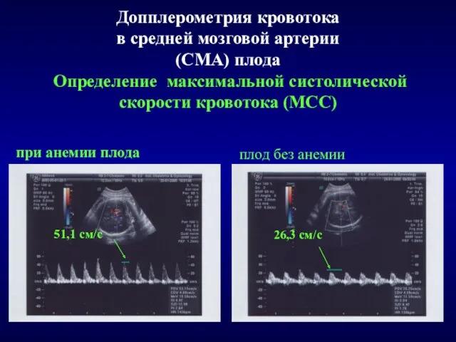 Допплерометрия кровотока в средней мозговой артерии (СМА) плода Определение максимальной