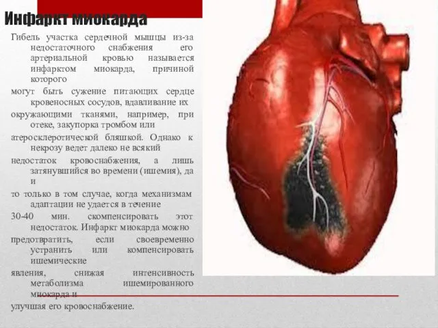 Инфаркт миокарда Гибель участка сердечной мышцы из-за недостаточного снабжения его